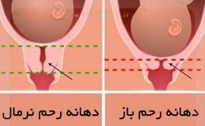 دهانه رحم باز