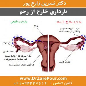 بارداری خارج از رحم