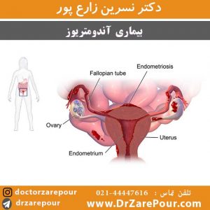 بیماری آندومتریوز