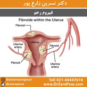 فیبروم رحم