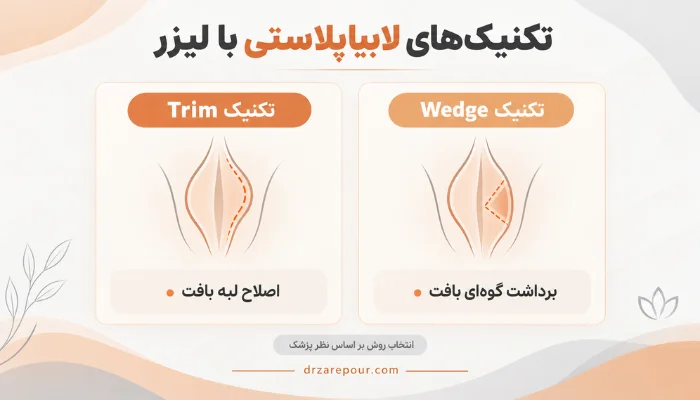 اینفوگرافیک مقایسه تکنیک Trim و Wedge در لابیاپلاستی با لیزر و نمایش تفاوت الگوی برش لبهای و گوهای