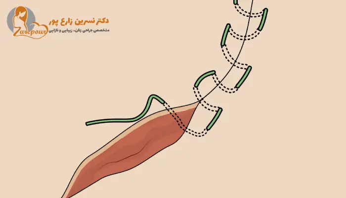 بخیه های لابیاپلاستی