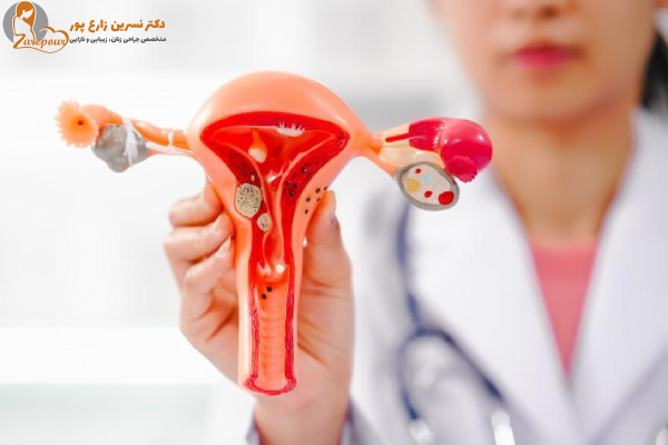 خطرات فیبروم رحم