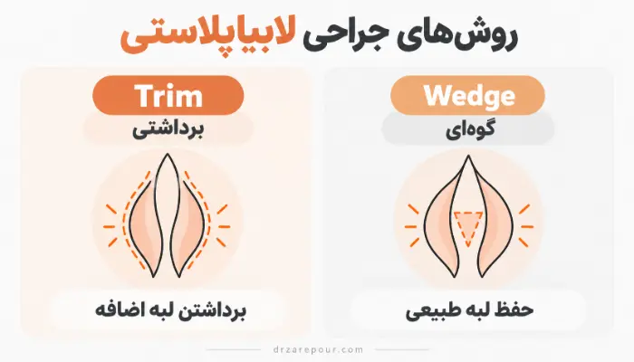 مقایسه روش Trim و Wedge در جراحی لابیاپلاستی