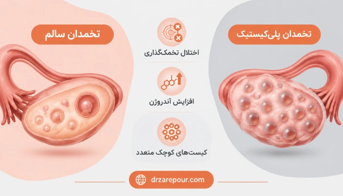 مقایسه تخمدان سالم و پلی کیستیک